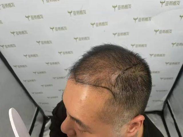 “还能反光<strong></p>
<p>btc期货</strong>！”长沙男子植发近9月称后脑勺“像狗啃过”
