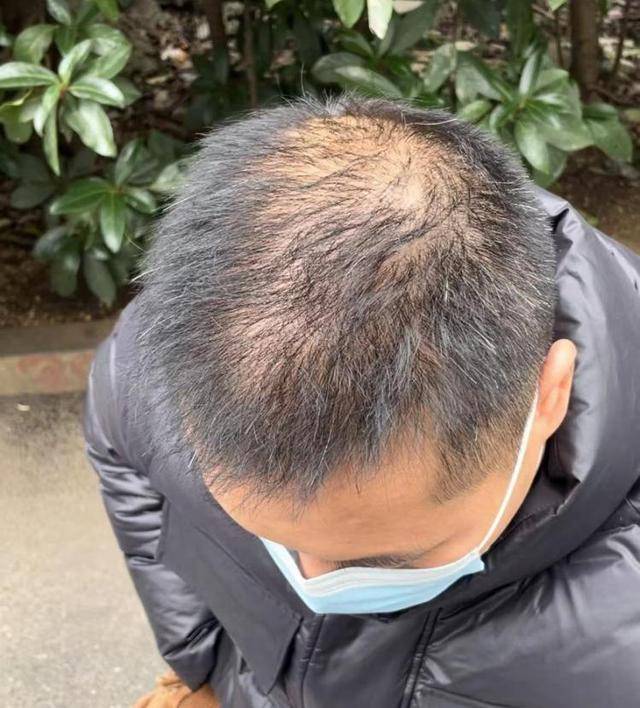“还能反光<strong></p>
<p>btc期货</strong>！”长沙男子植发近9月称后脑勺“像狗啃过”