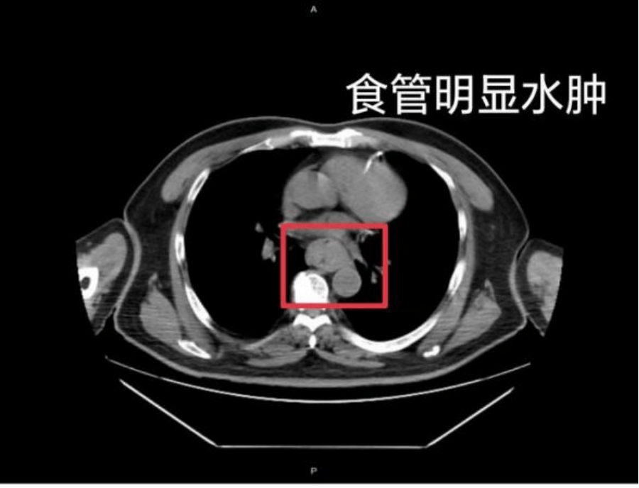 【家常话健康】一口热汤<strong></p>
<p>以太坊贸易</strong>，差点要了幼童的命！不是所有东西都适合“趁热吃”