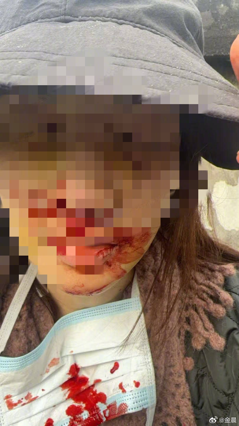 警方发布警情通报后<strong></p>
<p>比特币怎么买</strong>，金晨晒脸部受伤照片并发文道歉